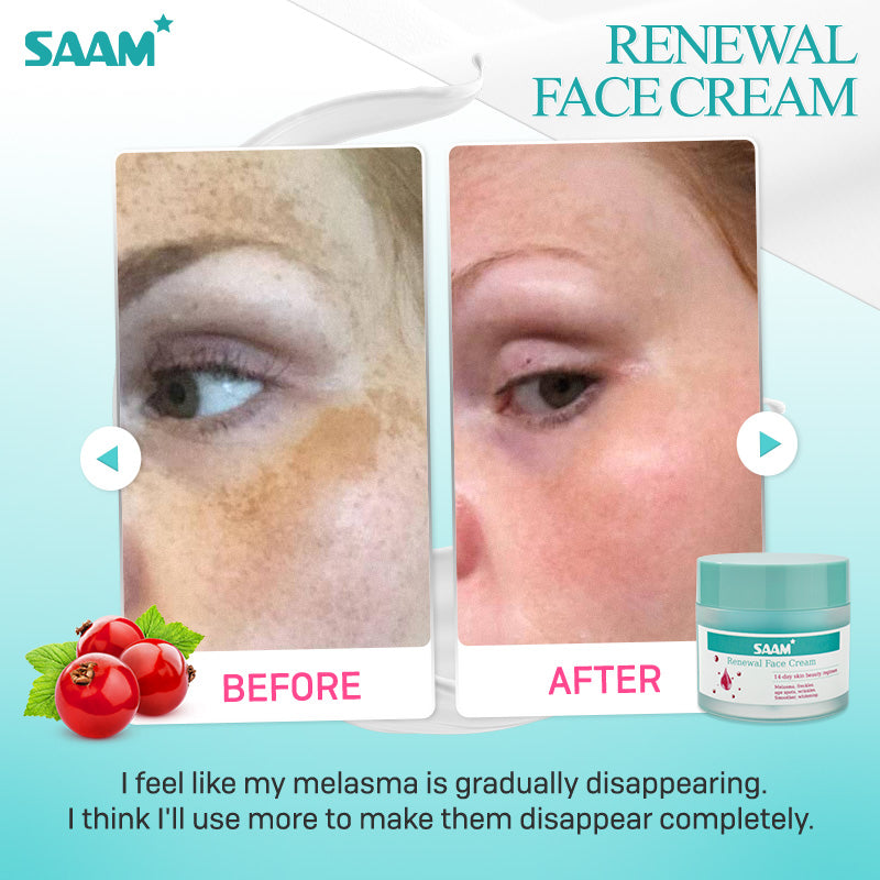 Face Cream Melasma and Freckles Treatment